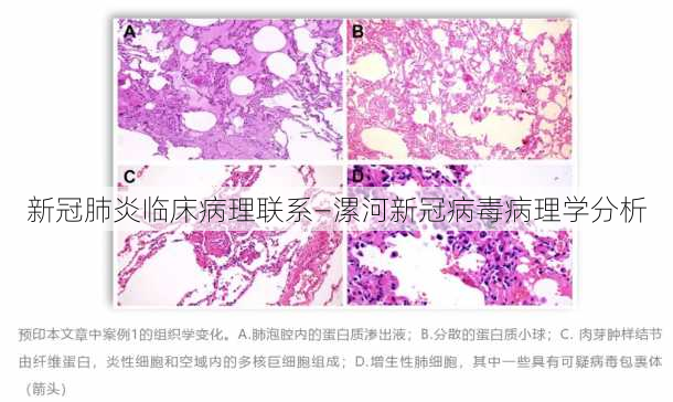 新冠肺炎临床病理联系—漯河新冠病毒病理学分析