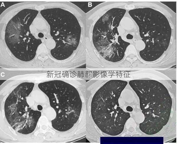 新冠确诊肺部影像学特征