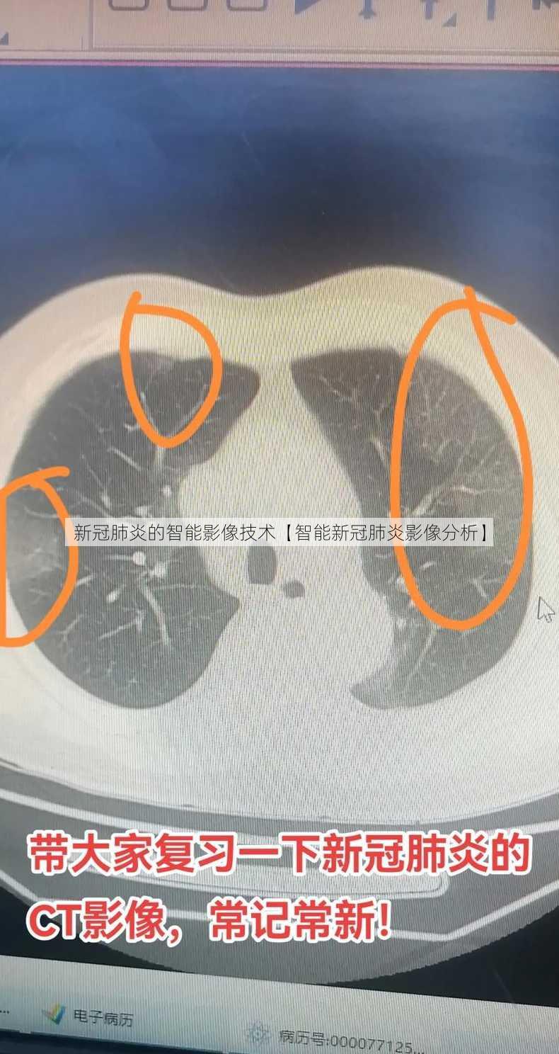 新冠肺炎的智能影像技术【智能新冠肺炎影像分析】