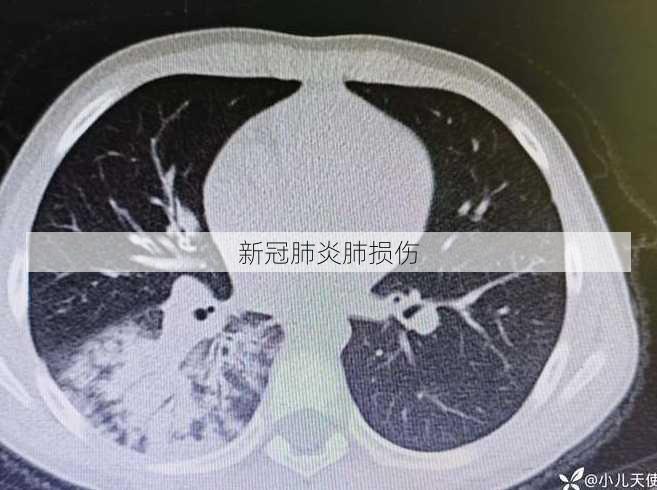 新冠肺炎肺损伤