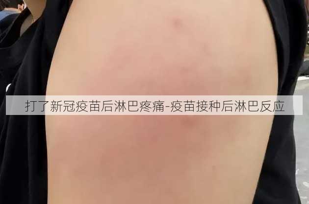 打了新冠疫苗后淋巴疼痛-疫苗接种后淋巴反应