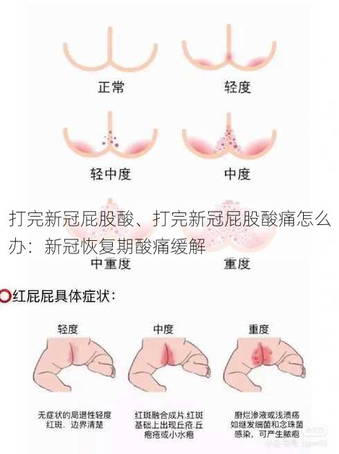 打完新冠屁股酸、打完新冠屁股酸痛怎么办：新冠恢复期酸痛缓解