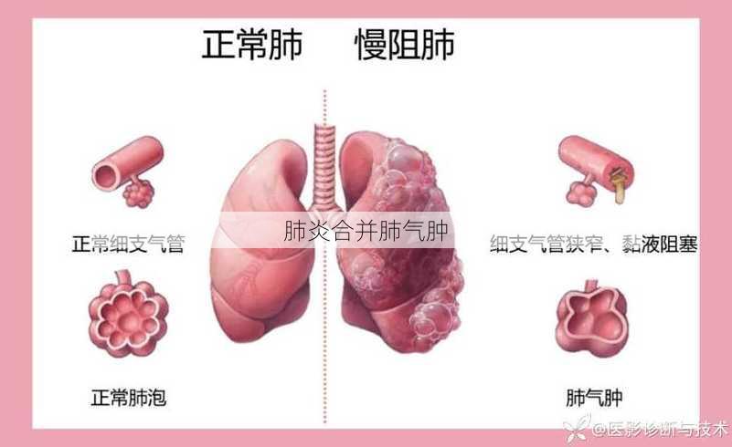 肺炎合并肺气肿