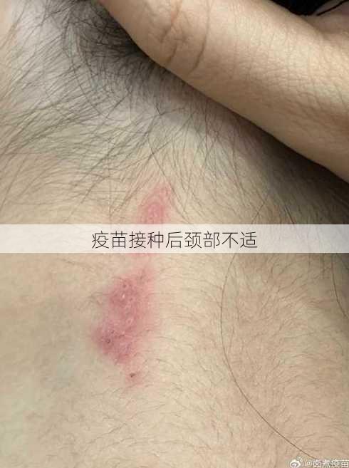 疫苗接种后颈部不适